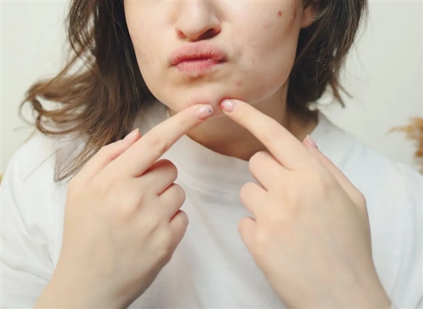 为什么有人总管不住手去挤痘痘(图2) 为什么有人总管不住手去挤痘痘