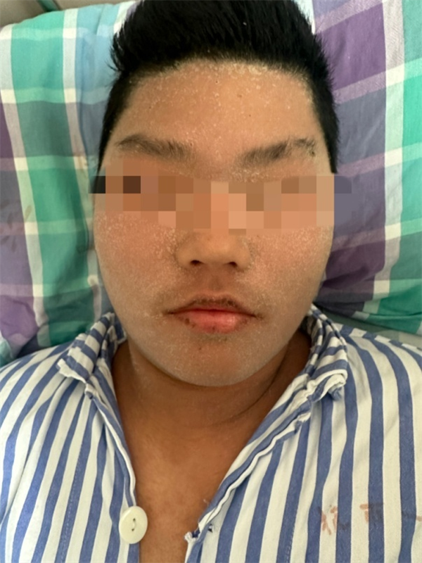 男生全身皮肤溃烂:“真凶”竟是这种水果!
