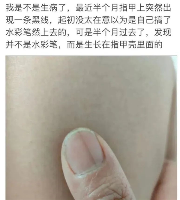 指甲出现一条黑线 别不当回事！可能是癌变