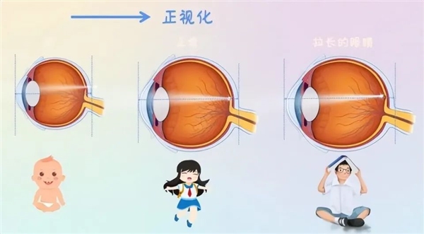 近视的人老之后：是视力逐渐变好 还是同时老花眼