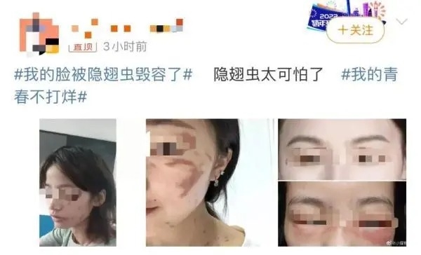 隐翅虫的毒液堪比硫酸!专家提醒:见到千万别拍